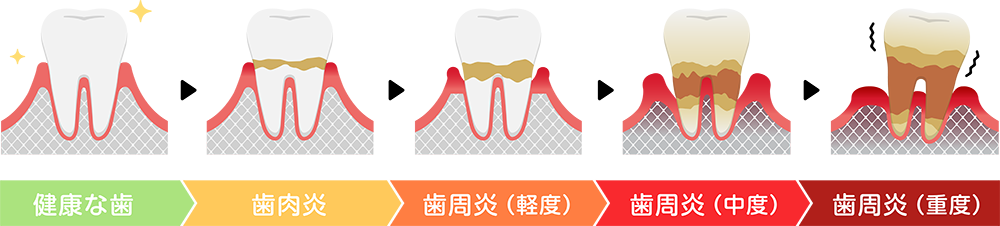 歯周病治療