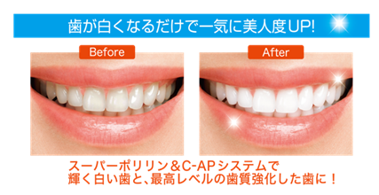 ホワイトニング